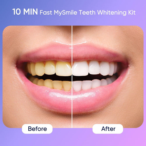 Deluxe 10 Min Teeth Whitening Kit with 28 LED Light, 35% Carbamide Peroxide Teeth Whitening Gel, Helps Remove Years of Stains from Coffee, Soda, Wines, Smoking, Food